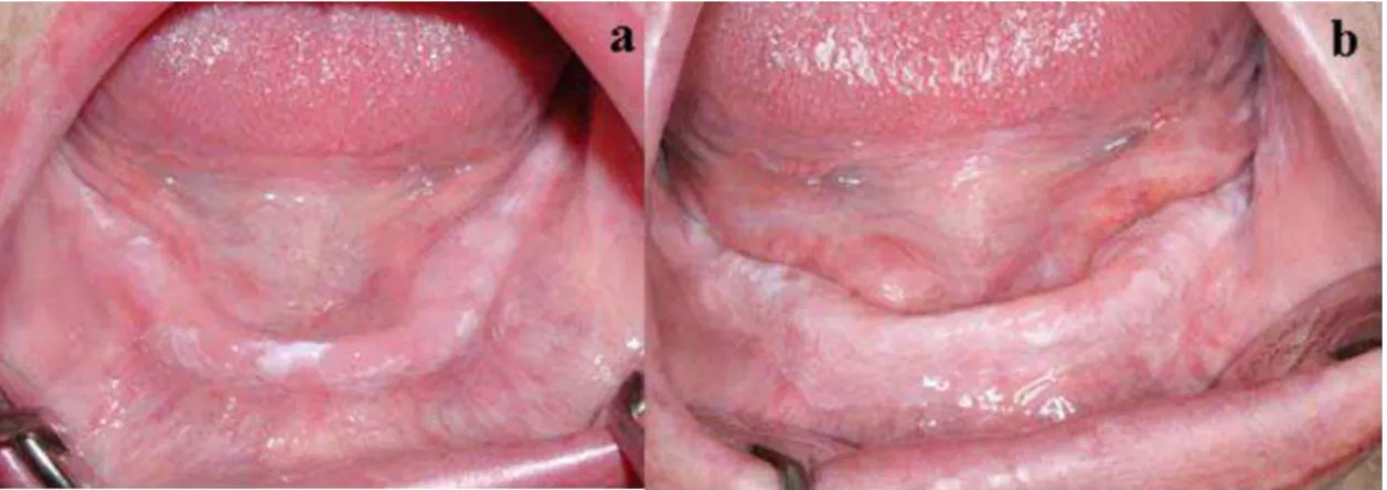 Figura 4: Agravamento com o tratamento com retinoides: a- antes do tratamento; b-  depois do tratamento 