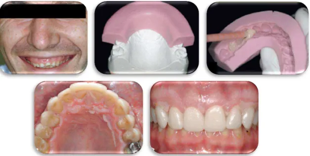 Figura 4 -  Mock- up vestibular maxilar (Vailati &amp; Belser, 2008a).