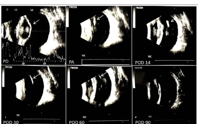 Figure 1 - Ultrasound images of the eyes of dogs who underwent phacoemulsification and implantation of a dexamethasone sustained- sustained-release device