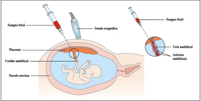Figura  1.3  –  Cordocentese  em  DPN.  Com  o  auxílio  de  uma  sonda  ecográfica  e  de  uma  agulha  é  retirado  sangue fetal a partir do cordão umbilical [adaptado de (Binns &amp; Hsu 2001)]