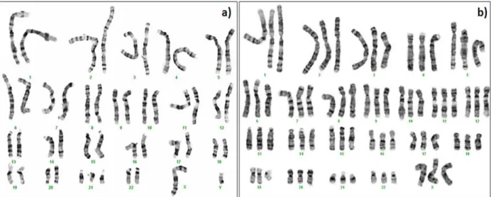 Figura  1.4  –  Alterações  cromossómicas  numéricas:  a)  trissomia  21  resultante  de  um  cromossoma  21  extra  (47,XY,+21); b) triploidia (3n) com um total de 69 cromossomas (69,XXX) (imagem cedida pelo laboratório  de Citogenética e Genómica, Faculd