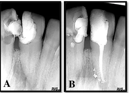 Figura  3: A: Radiografia inicial do dente 1.1 com diagnóstico de PAC. B: Radiografia  final  pós-TENC com  visualização de selamento  de canais  acessórios