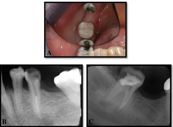 Figura  9:  A:  Fotografia  do  dente  4.5  restaurado.  B  e  C:  Radiografias  exemplares  de  dentes com instrumentos fracturados no interior do SCR