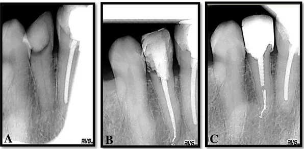 Figura 13 : A: Restauração provisória incial no dente 2.2, com diagnóstico de Necrose  Pulpar