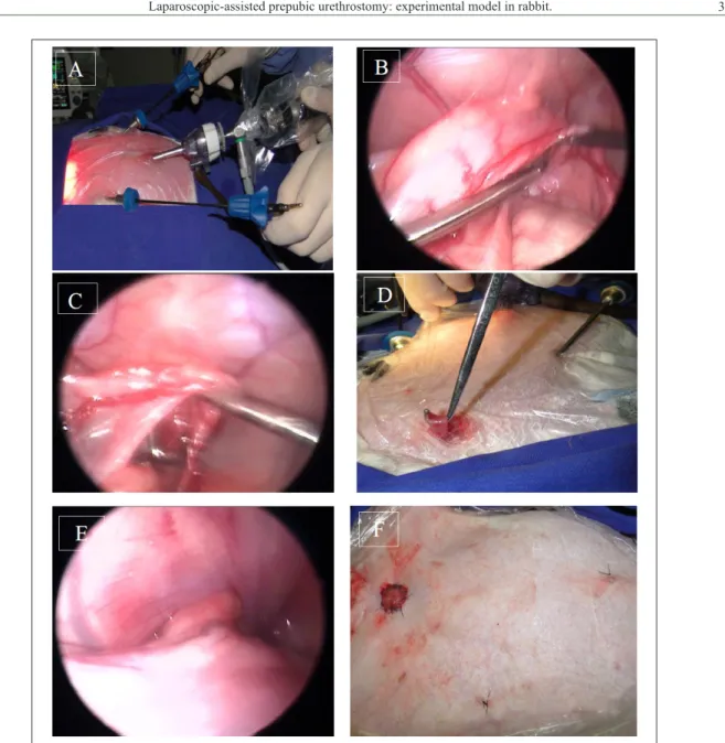 Figure 1 - A. Trocar position for laparoscopic-assisted PPU surgery. Note portal triangulation