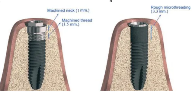 Figura 4: Nível de inserção dos implantes; (A) Implante de Conexão Externa; (B) Implante de Conexão  Interna