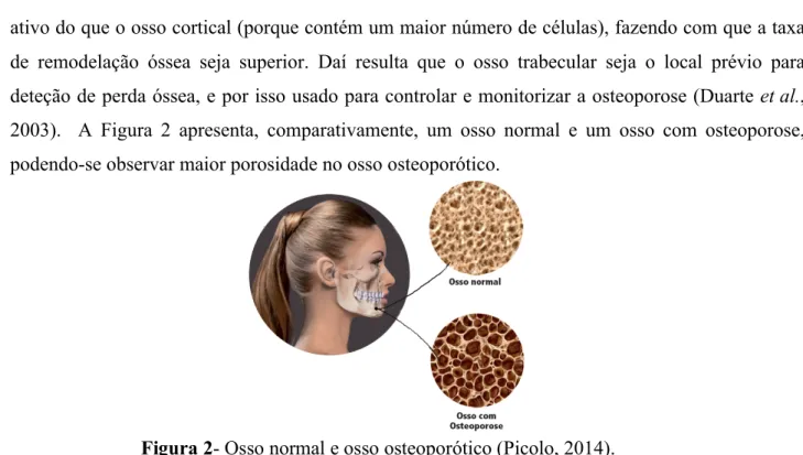 Figura 2- Osso normal e osso osteoporótico (Picolo, 2014). 