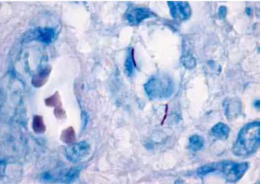 Figura 4 - Bacilos de micobactéria identificados pela coloração de Ziehl-Neelsen, num granuloma  (Adaptado de Anexo 1)