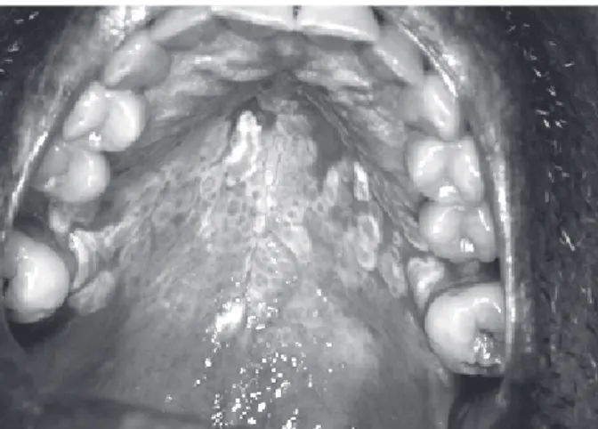 Figura 1. Manifestações da DECHc na cavidade oral sem  comprometimento dos dentes no D+ 224