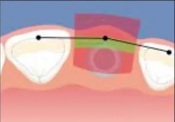 Figura  3:  Posição  ideal  do  implante  imediato  no  sentido  vestíbulo-palatino  (Buser  et  al., 2004)