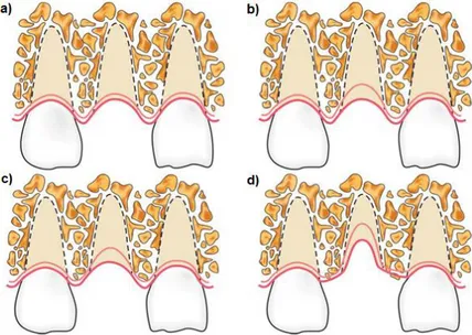 Figura 4: Classificação de Caplanis e colaboradores (2009) para os defeitos alveolares  pós-exodontia