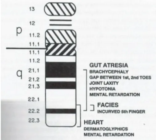 Figura 1: Mapa do fenótipo do cromossoma 21 (adaptada de Morato, 1994:61) 