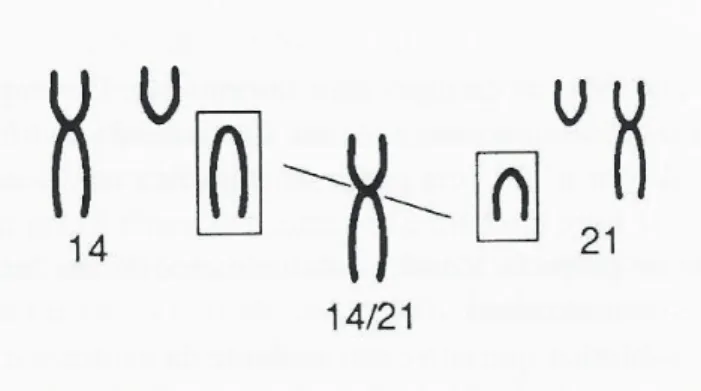 Figura 4: Translocação do cromossoma 21 (adaptada de Folhetos SNR, 2001:20). 