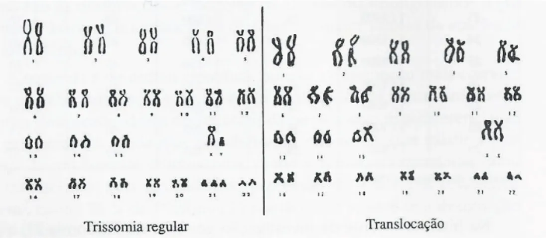 Figura 5: Cariótipos da trissomia regular e da translocação (adaptada de Crome e Stern, 1971,  citados por Morato, 1994:57)