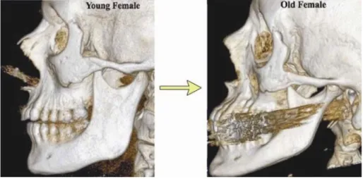 Figura 5- Alterações da mandíbula – mulher jovem (esquerda) e idosa (direita) (Ghaffari, 2013)
