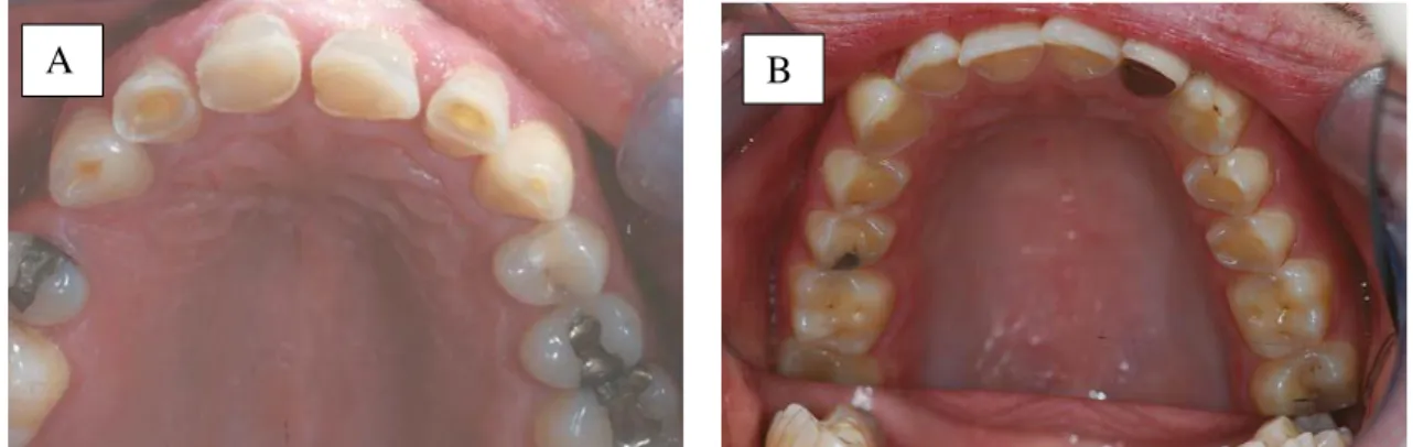 Figura 9 - Desgaste dentário. Combinação de erosão e atrição (A); Erosão (B)  (Bartlett &amp; Dugmore, 2008)