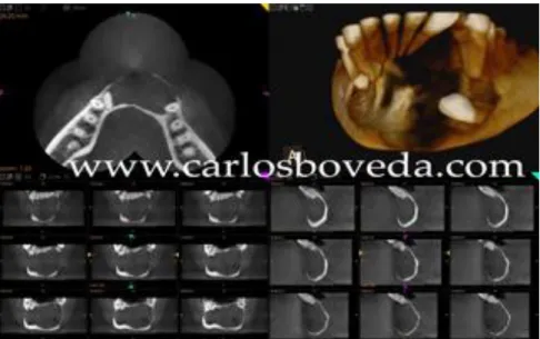 Figura 9 – Lesão quística visualizada por CBCT (In http://www.carlosboveda.com/tvd.htm ) 