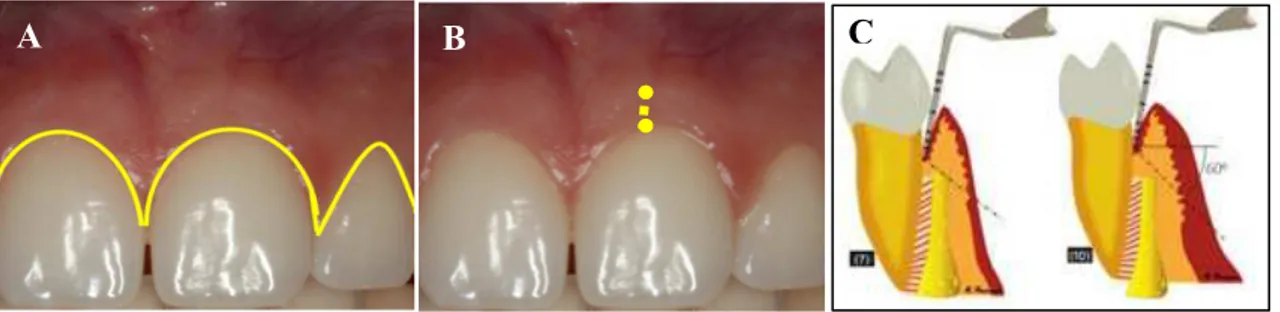 Figura  2-  Caraterísticas  dos  tecidos  gengivais  e  periodontais  quanto  a  (A)  -Contorno  alveolar;  (B)  - -Largura alveolar; (C) -Espessura Gengival (Passanezi, 2011)