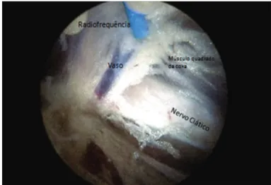 Figura 5 – Aspecto do artroscópio em direção ao forame isquiá­