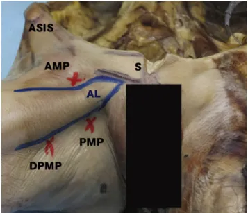 Fig 2. (A) Left hip positioned at 70  of ﬂ exion, 70  of abduction, and maximum external rotation, showing relation between portals (represented by Steinmann pins) and adductor longus muscle (AL)
