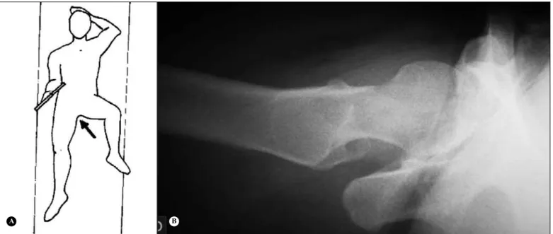 Figura 11 –  A) Radiografia de bacia Lauenstein. Paciente em  posição  supina  com  dupla  abdução  dos  membros  inferiores; 