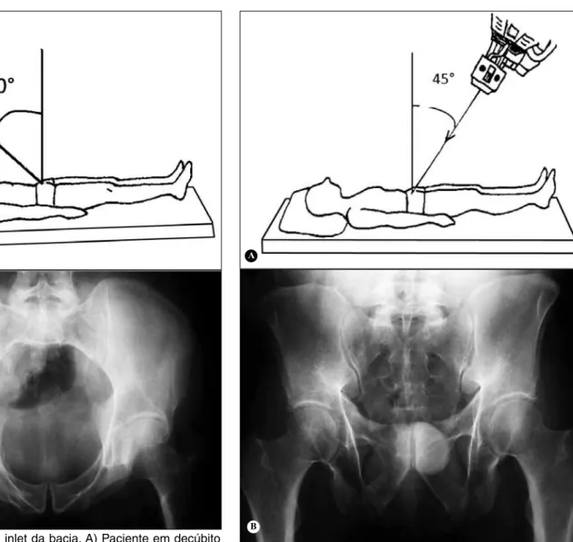 Figura 17 – Incidência outlet da bacia. A) Paciente em decúbito  dorsal horizontal, com raio incidente no sentido caudo-cranial com  angulação de 45°