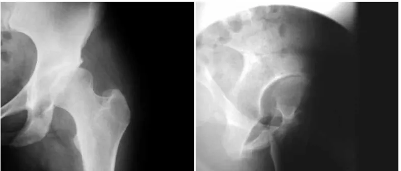 Figura  19  –  Radiografia  AP  de  bacia  com  coxa  profunda  do  quadril direito e protrusão do quadril esquerdo.