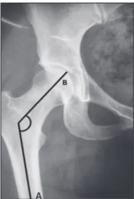 Figure 7. Cervico-diaphyseal angle–it is the angle formed by  the axis of the femoral shaft (line A) and the line a drawn along  the axis of the femoral neck passing through the femoral head  center (line B).