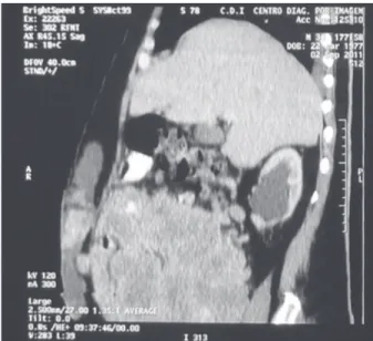 Figura 2. Tomografia computadorizada em corte sagital na qual  se observa lesão expansiva em abdome inferior com implantes  peritoneais  