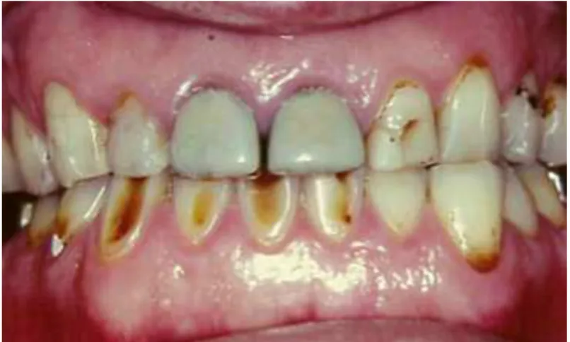 Figura 11. Paciente com erosão dentária em estado avançado; aspeto amarelado e vítreo  nas superficies vestibulares dos dentes anteriores (Fonte: Branco et al., 2008)