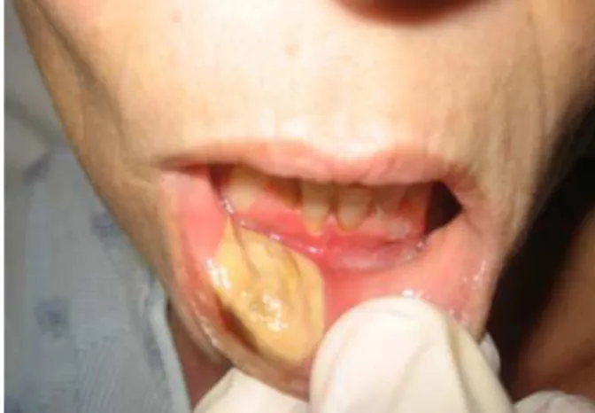 Figura 13. Vista anterior de lesão na mucosa do lábio inferior compatível com o uso de  cocaína (Fonte: Pillow e Cuthbertson, 2012)