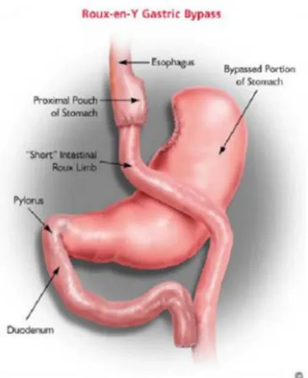 Figura 6 -  Técnica Fobi Capela (Y de Roux) 