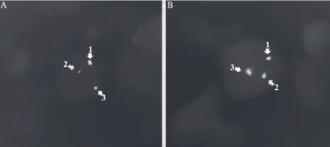 Figura 2. A análise de alterações citogenético-moleculares no gene  FOXO1 em rabdomiossarcoma alveolar, mostrando em (A1) gene  FOXO1, sinal de fusão normal do gene FOXO1, mostrando que  este alelo está intacto (ao microscópio esse sinal é representado pel