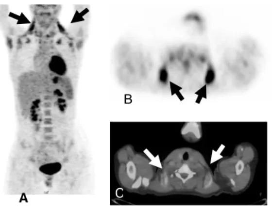 Figure 3 - This 6 year old child underwent PET/CT for evaluation of right supraclavicular  lymphadenopathy