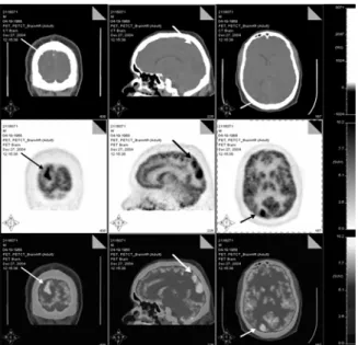 Figure 4 - Coronal, Sagital, and axial PET/CT images of the brain that shows a focal area of  increased metabolism within the Right occipital lobe (arrow)