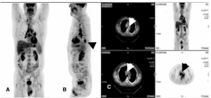 Figure 5 - Whole Body PET/CT (A and B) was performed on this 62 year old male to stage his  known lung adenocarcinoma involving the left lower lobe (arrow in B)