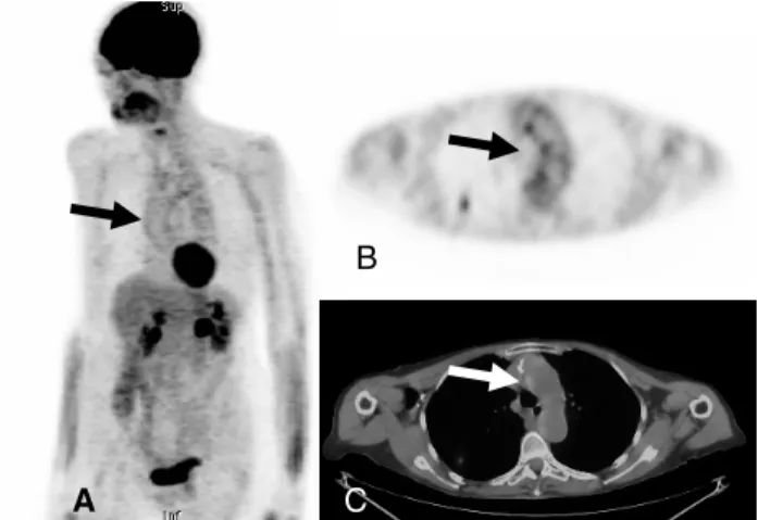 Figure 6 - This 72 year old female presented for evaluation of a right upper lobe mass