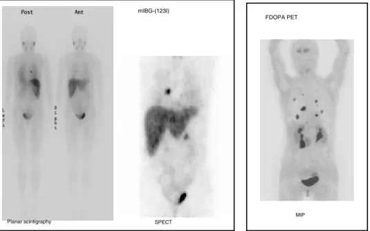 Figure 3 - Patient operated 4 years before from a phaeochromocytoma of the left adrenal gland