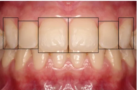 Figura 3 – Simetria Dentária dos dentes anteriores. 