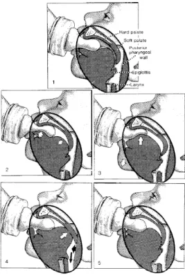 Figura 2 – Mecanismo de sucção no aleitamento por biberão, segundo Weiss (2003).