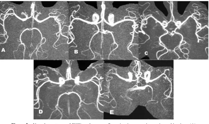 Figure  2  -  Vascular  patterns  of  Willis  polygon  configuration  in  a  superior  angiographic  view:  (A)  classical  standard  of  distribution,  (B)  presence  of  unilateral  and  (C)  bilateralfetal  PCommA, (D) hypoplasia of one and (E) both PCo