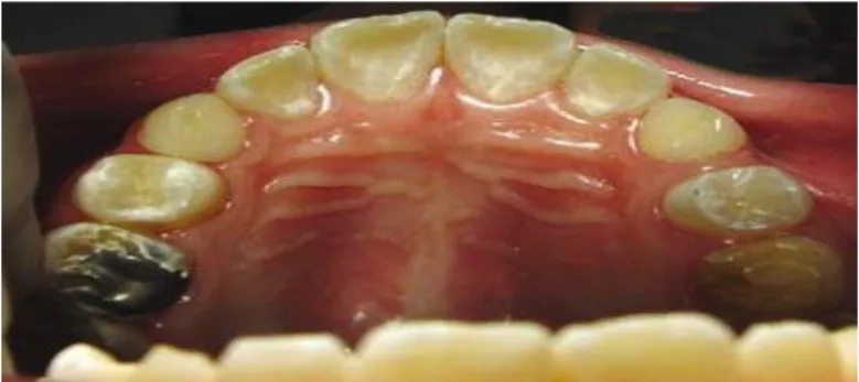 Figura  1-  Erosão  dentária  na  face  palatina  dos  incisivos  superiores  (Fonte  de  Guedes et al., 2007)