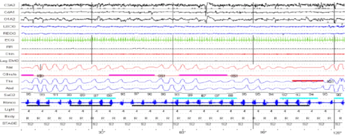 Fig. 7 – Traçado polissonográfico evidenciando hipopneia (traçado cor de rosa), apneia  obstrutiva (traçado vermelho), dessaturação da oxihemoglobina (traçado azul claro) e  roncos (traçado preto) (Adaptado de Caixeta et al., 2010)