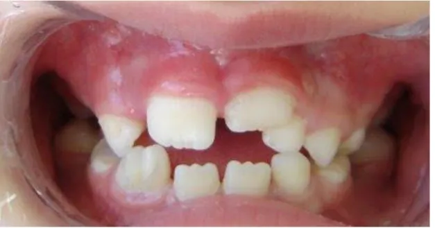 Figura 6 - Agenesias dentárias  2.4.1 Doença Periodontal 