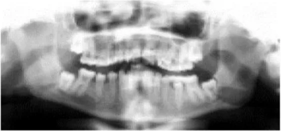 Figura 7 - Radiografia panorâmica de uma menina de 11 anos de idade, portadora  de SD com taurodontismo e anodontia 