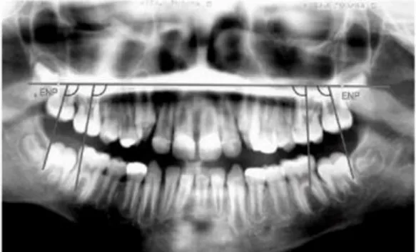 Figura 9 - radiografia panorâmica de má oclusão dentária  Fonte: Revista Dental Press de Ortodontia  