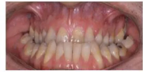 Figura 10  –  Má oclusão de classe III de paciente com SD, com mordida posterior  bilateral provocada por desgaste dentário  