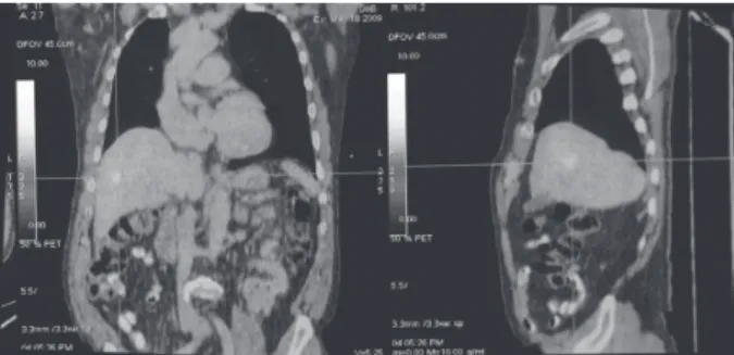 Figura 1. PET-CT mostrando aumento focal da concentração de  18F-FDG em parênquima hepático