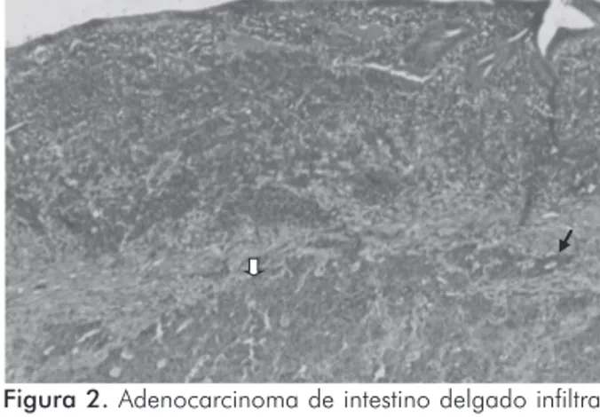 Figura 2. Adenocarcinoma de intestino delgado infiltrando toda a  espessura da parede intestinal