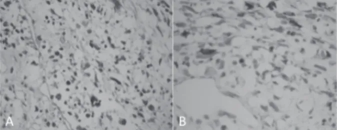 Figura 1. Diagnóstico histopatológico. A. Fotomicrografia RMS  embrionário com dois padrões morfológicos de rabdomioblastos: 